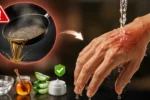 چگونه سوختگی پوست ناشی از روغن داغ را سریع درمان کنیم؟