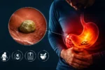 سنگ معده چیست و چه علائمی دارد؟ روش درمان سنگ معده