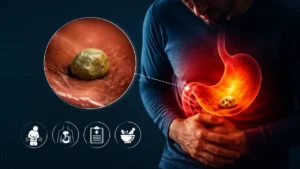 سنگ معده چیست و چه علائمی دارد؟ روش درمان سنگ معده