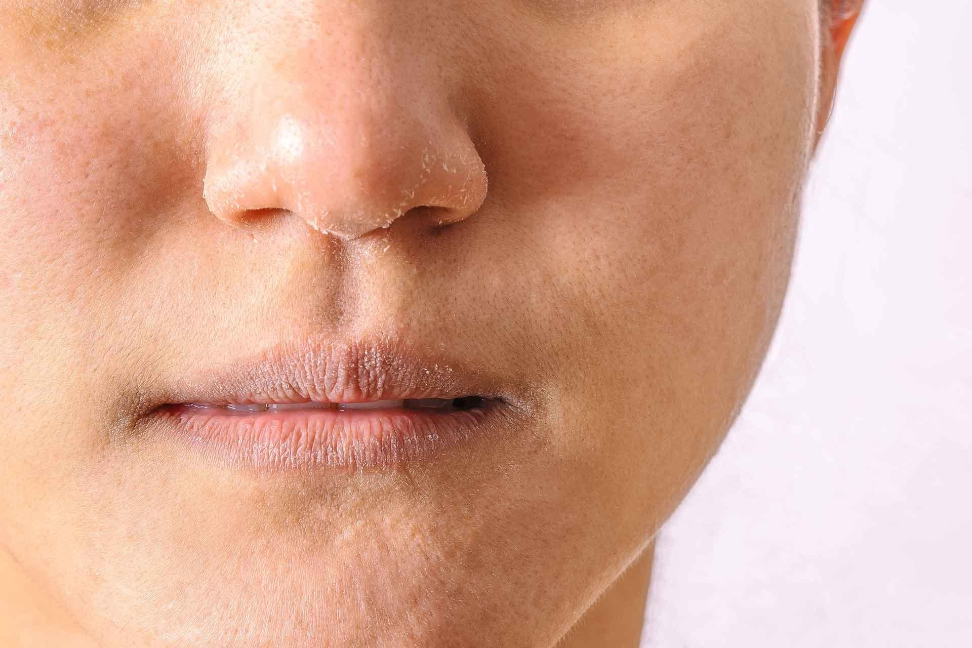 برای خشکی داخل بینی چی خوبه؟