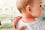 درمان های خانگی و بهترین پماد برای عرق سوز شدن گردن نوزاد