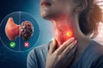 چه زمانی ندول تیروئید خطرناک است؟ علائم ندول خوش خیم و بدخیم تیروئید