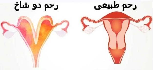 رحم دو شاخ چیست؟